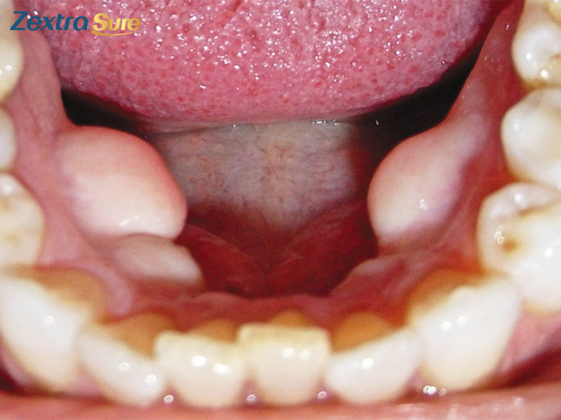 Mandibular-tori-cancer (4)
